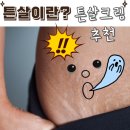 튼살이란? 임산부튼살크림 추천!