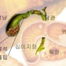 담낭염의 원인 증상 치료 이미지