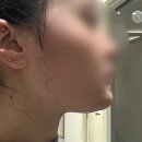 이&박의원 | 강남역 신논현역 피부과 심부볼과 턱살 부자의 내돈내산 튠라이너 후기