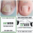힐앤풋