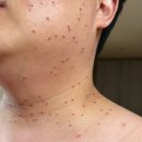 부산대 미의원 피부과 쥐젖 점 편평사마귀 제거후기