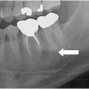 근단 주위 농양 (Periapical abscess with sinus) 치과질환이란? 이미지