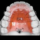 도화더본치과의원 | 악궁확장장치 통한 주안 치과 교정 적절한 시기 성장기가 중요한 이유