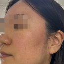 명현네슈퍼 | 주사피부염 극복 후기 (사진O, 광고아님)