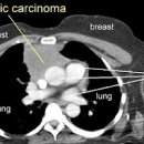 흉선종, 흉선암 증상 및 치료 (가슴흉통 잦은기침 호흡곤란) 이미지
