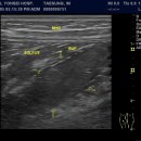 soleus muscle rupture 이미지