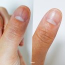 엄지 손톱 검은세로줄 병원 ‘어디로’ 가야 할까? (진료 후기 + 전후 비교까지!)