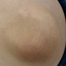 송스샵 | 일산멜라닌케어 전문 색소침착 송스뷰티 팔꿈치 후기