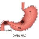 십이지장 궤양 이미지