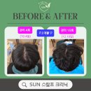 선영에너지 | 두피 건강 회복을 이끄는 탈모화타 선영