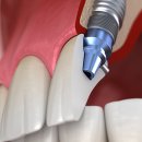 서울장플란트치과의원 | 임플란트 부작용 사례와 해결방법 알아보기