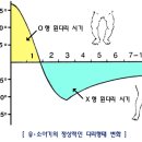 내반슬 외반슬 이미지