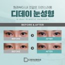 디데이성형외과의원 네이버블로그