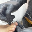 황금초등학교 | 대구 내성발톱 병원 수술없이 교정 시술 잘하는곳 르엘라 푸스케어