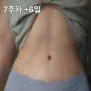 거상환경 | 복부거상 복부성형 체크리스트 1/3 ✅️압구정 탱글성형외과👈 체형전문 15년차 성형외과 전문의 오창현...