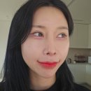 뷰메디칼 | 부산피부과추천 쥬베룩볼륨 3cc 팔자주름 사라진 후기 서면피부과