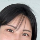 4공단로1L-30 | 자연유착 매몰법 쌍수 2주차, 붓기 빠지고 라인 잡은 리얼후기