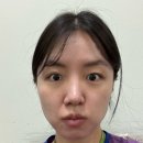 타이탄 | 신사역피부과 이브타이탄 후기