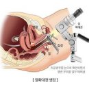 자궁경부암 및 원인 검사방법은 이미지