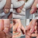 네일아린 | 양재 네일샵, 손톱 표면 울퉁불퉁 네일 케어 후기