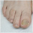 장유맑은이비인후과의원 | 발톱무좀 치료 미루지마세요 ! 맑은소리이비인후과 치료 후기.