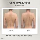 로타리컴퓨터 | 부산웨딩관리 추천, 승모근 라운드숄더 고민 해결한 달리핀에스테틱 여리핏 후기