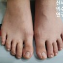 신세계 의수족 연구소 네이버블로그