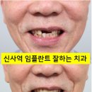 마이플란트치과기공소 | 신사역 앞니 임플란트 잘하는 레브치과. 가격/비용/사진/후기. (프로포폴 수면가능)