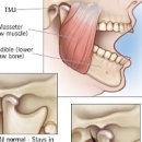턱관절 장애 증상 및 치료 (턱통증 턱근육통증 턱소리) 이미지