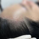 [마곡두피문신] &#39;올블랙닷&#39; 마곡헤어라인 3차 커버 후기