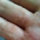 한국한센복지협회울산경남지부마산부설의원 | (창원지역)한포진, 정말 낫지 않는 병일까요?