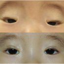 선천성안검하수의 특수한 경우-눈꺼풀 축소 증후군, Jaw-winking현상 이미지