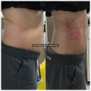 소사벌레포츠타운-우 | [평택다이어트] 오늘도예쁨, 복부 라인이 신경 쓰일 때 받은 테라피 후기