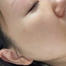 아이피부과 | 마곡피부과 쥬베룩 아이 후기 I 눈밑 꺼짐 고민 주목 I 전후비교