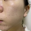 크림리서치 | 기미크림 추천, 더마리서치 멜라티논 크림 찐 효과 후기
