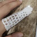 이조케터링(주)서산지원 | 서산 우리본병원 :: 탈구 골절 수술 입원 후기 _ 정형외과 양하솔원장님