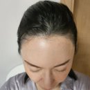히든헤어 - 해운대구 | 강남모발이식 남자/여자 M자 탈모 헤어라인 히든컷 수술 추천 9개월 후기