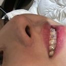 투스젬 제거 후기 :: 투스젬 제거 꼭 치과 가야하냐 묻는다면 네