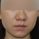 군산 기미 치료 레이저 제대로 하는 법?
