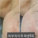 세종피부관리 /고운동 골프라운딩후 예민하고 건조한피부관리는 황정아뷰티샵