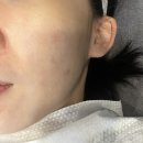 세븐일레븐인천간석도담점 | [뷰티리셋] 구월동 여드름 압출 전문 케어