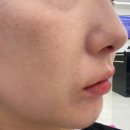 천안 스킨보톡스｜리쥬란+더마샤인 내돈내산｜리프팅 시술 가격 정보 후기