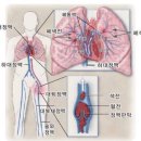 의료 폐혈전색전증 이미지