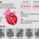 심실세동 원인 심장박동수 부정맥 전조증상 이미지