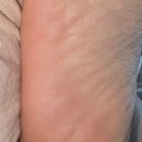 수정수진2-D-4 | 베루말액+비타민D 주사로 사마귀를 완치해보자!!(사마귀 제거 후기 4탄)