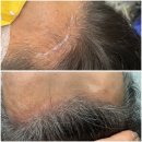 신원로3 | 글램유smp | 60대 헤어라인 SMP 1-3차 시술 솔직 후기 (삼송두피관리·일산smp)