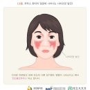 희귀병 루푸스 정복을 위해 한 걸음 더, 한국인 면역유전자 참조패널 개발 이미지