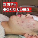 경기도 수원시 권선구 권선로 738 (권선동) | 수원 여드름 염증주사 없이 권선동 에스테틱 압출로 좋아진 후기