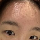 구성역 | 구성역 피부과 포텐자 후기 레이저 토닝 가격 붓기 통증