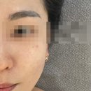 [광주/서구/쌍촌동] 광주 피부재생술 트로이필 후기, 수얀스킨케어 광주